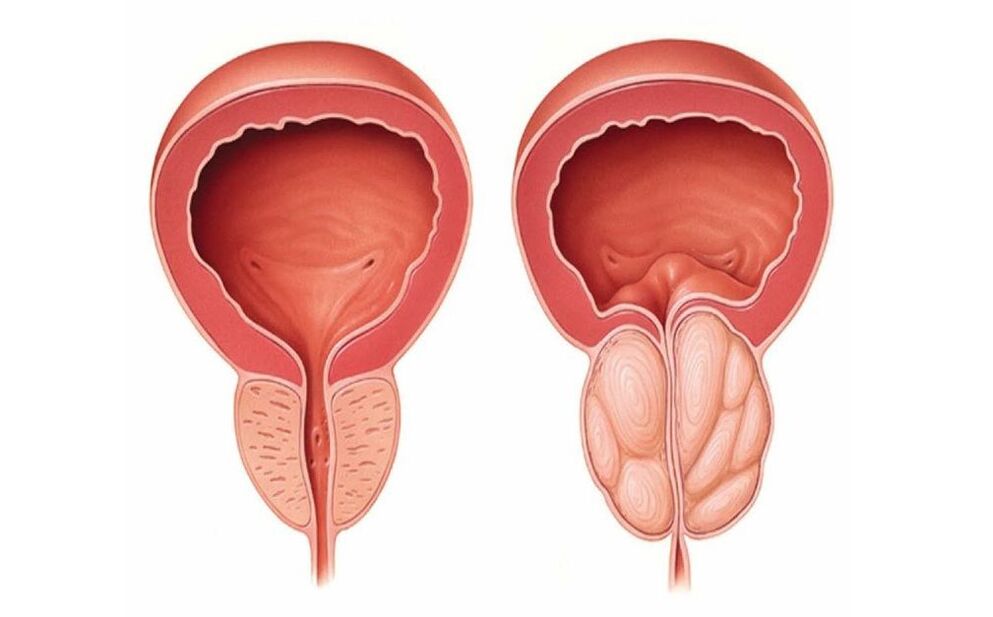 normalna i upaljena prostata