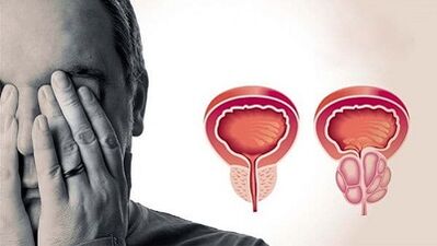 Razlozi razvoja prostatitisa kod muškaraca