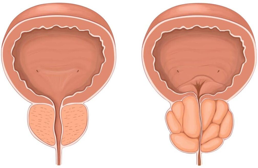 Kako izgleda upala prostate