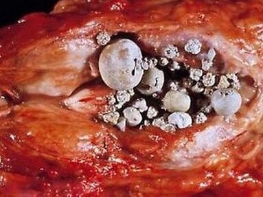 Kamenje u prostati s kalkuloznim prostatitisom
