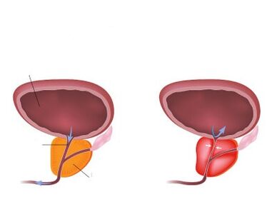 Normalna i upaljena prostata